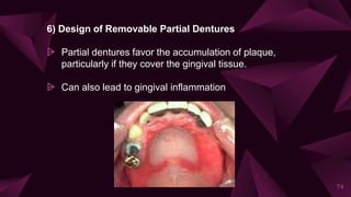 6) Design of Removable Partial Dentures
⩥ Partial dentures favor the accumulation of plaque,
particularly if they cover the gingival tissue.
⩥ Can also lead to gingival inflammation
74
 