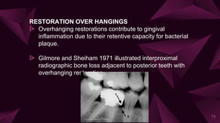 RESTORATION OVER HANGINGS
⩥ Overhanging restorations contribute to gingival
inflammation due to their retentive capacity for bacterial
plaque.
⩥ Gilmore and Sheiham 1971 illustrated interproximal
radiographic bone loss adjacent to posterior teeth with
overhanging restoration.
79
 