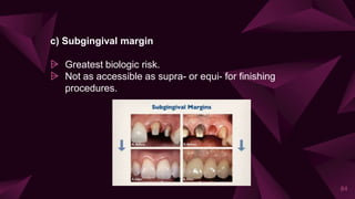 c) Subgingival margin
⩥ Greatest biologic risk.
⩥ Not as accessible as supra- or equi- for finishing
procedures.
84
 