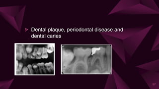 ⩥ Dental plaque, periodontal disease and
dental caries
97
 