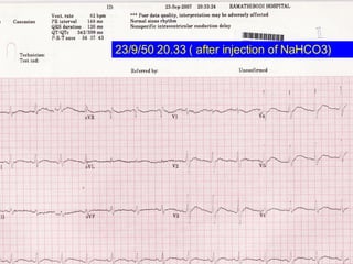 23/9/50 20.33   ( after injection of NaHCO3) 