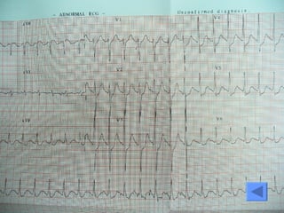 EKG 12 leads  