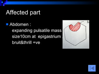 Abdomen :  expanding pulsatile mass ,  size10cm at  epigastrium ,  bruit&thrill +ve  Affected part 