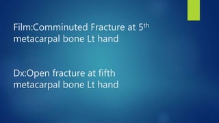 Film:Comminuted Fracture at 5th
metacarpal bone Lt hand
Dx:Open fracture at fifth
metacarpal bone Lt hand
 