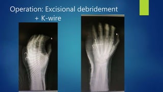 Operation: Excisional debridement
+ K-wire
 