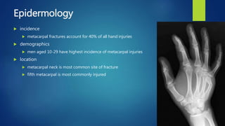 Epidermology
 incidence
 metacarpal fractures account for 40% of all hand injuries
 demographics
 men aged 10-29 have highest incidence of metacarpal injuries
 location
 metacarpal neck is most common site of fracture
 fifth metacarpal is most commonly injured
 