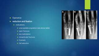  Operative
 reduction and fixation
 indications
 unacceptable angulation (see above table)
 open fractures
 any malrotation
 intraarticular fractures
 Cosmetic
 Fail reduction
 