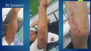 Rt forearm
 