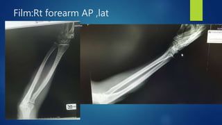 Film:Rt forearm AP ,lat
 