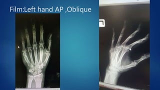 Film:Left hand AP ,Oblique
 