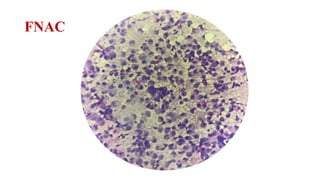 Pleura Cytology