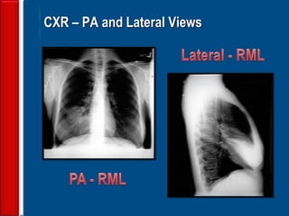 101
CXR – PA and Lateral Views
 