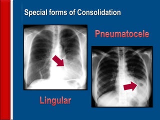 104
Special forms of Consolidation
 