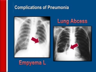 108
Complications of Pneumonia
 