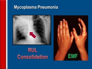 111
Mycoplasma Pneumonia
 
