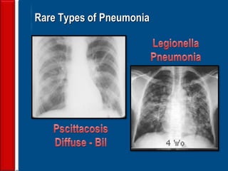 113
Rare Types of Pneumonia
 
