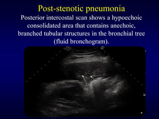 Post-stenotic pneumonia
Posterior intercostal scan shows a hypoechoic
consolidated area that contains anechoic,
branched tubular structures in the bronchial tree
(fluid bronchogram).
 