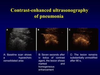Contrast-enhanced ultrasonography
of pneumonia
A: Baseline scan shows
a hypoechoic
consolidated area
B: Seven seconds after
iv bolus of contrast
agent, the lesion shows
marked and
homogeneous
enhancement
C: The lesion remains
substantially unmodified
after 90 s.
 