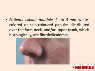 • Patients exhibit multiple 1- to 5-mm white-
colored or skin-coloured papules distributed
over the face, neck, and/or upper trunk, which
histologically, are fibrofolliculomas.
 