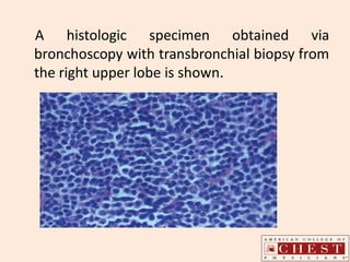 A histologic specimen obtained via
bronchoscopy with transbronchial biopsy from
the right upper lobe is shown.
 