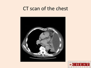 CT scan of the chest
 