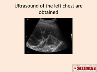 Ultrasound of the left chest are
obtained
 