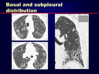 Basal and subpleural
distribution
UIP
 