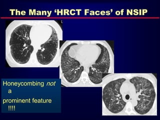 The Many ‘HRCT Faces’ of NSIP
Honeycombing not
a
prominent feature
!!!!
 