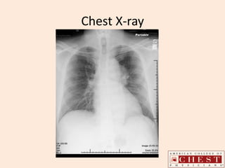 Chest X-ray
 
