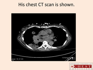His chest CT scan is shown.
 