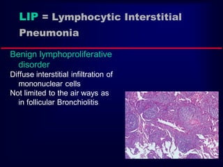 Benign lymphoproliferative
disorder
Diffuse interstitial infiltration of
mononuclear cells
Not limited to the air ways as
in follicular Bronchiolitis
LIP = Lymphocytic Interstitial
Pneumonia
 