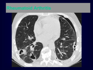 Rheumatoid Arthritis
 