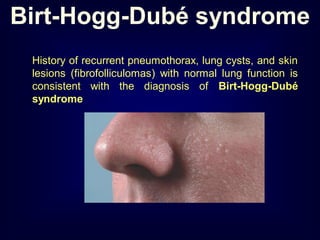 History of recurrent pneumothorax, lung cysts, and skin
lesions (fibrofolliculomas) with normal lung function is
consistent with the diagnosis of Birt-Hogg-Dubé
syndrome
Birt-Hogg-Dubé syndrome
 