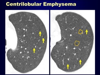 Centrilobular Emphysema
 