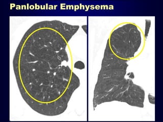 Panlobular Emphysema
 
