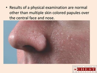 • Results of a physical examination are normal
other than multiple skin colored papules over
the central face and nose.
 