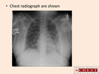 • Chest radiograph are shown
 