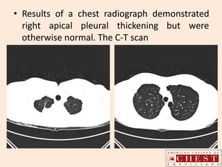 • Results of a chest radiograph demonstrated
right apical pleural thickening but were
otherwise normal. The C-T scan
 