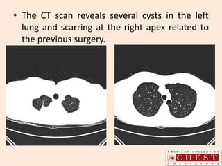 • The CT scan reveals several cysts in the left
lung and scarring at the right apex related to
the previous surgery.
 