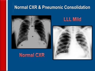 99
Normal CXR & Pneumonic Consolidation
 