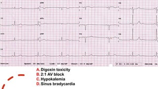 INTERESTING ECGS | PPTX