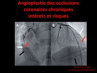 Angioplastie des occlusions
coronaires chroniques
intérets et risques
Carole Daire Chaboy
Le confluent hopital privé Nantes
 