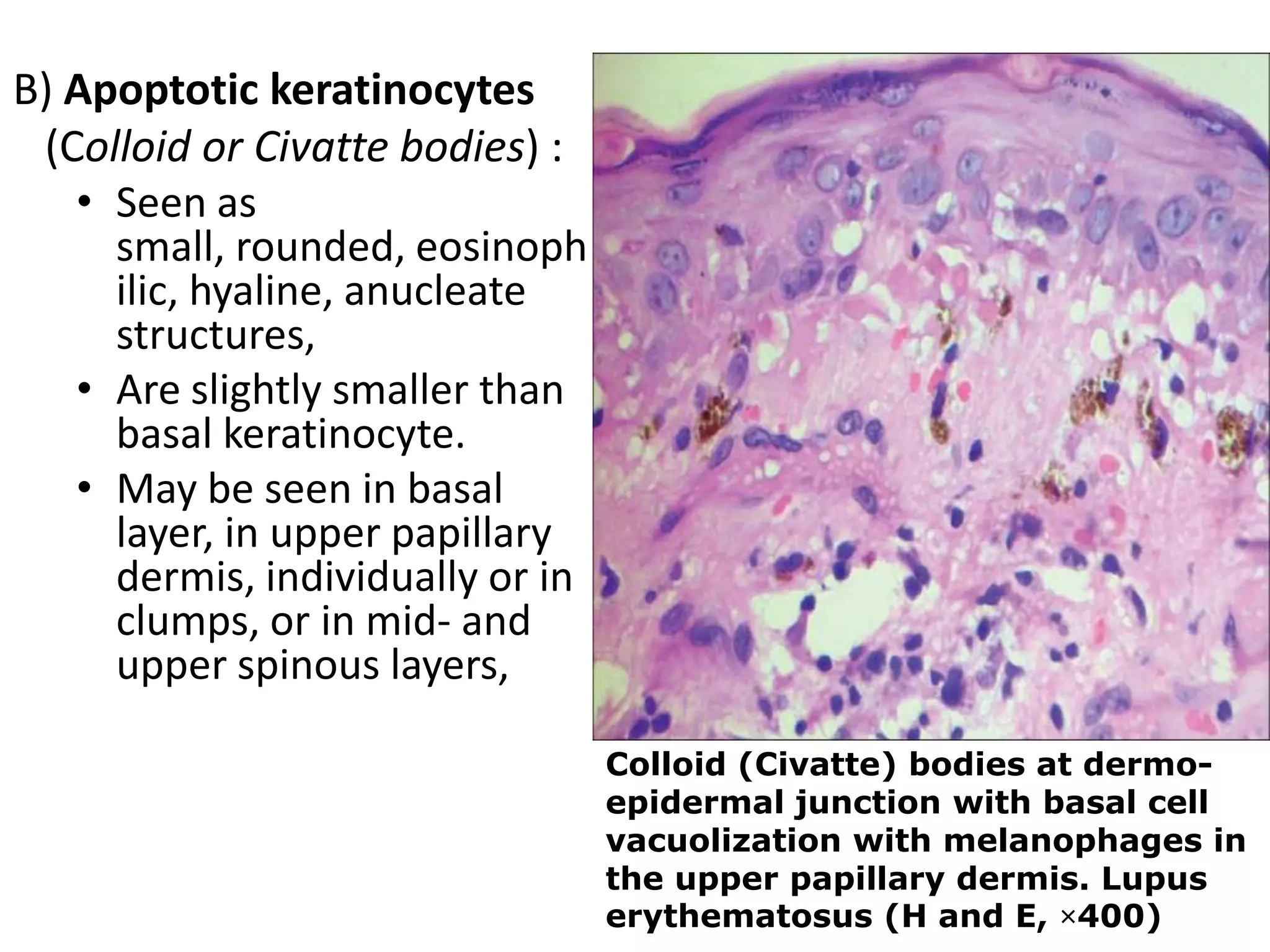 Interface dermatitis tutorial | PPT