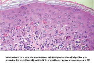 Numerous necrotic keratinocytes scattered in lower spinous zone with lymphocytes
obscuring dermo-epidermal junction. Note normal basket weave stratum corneum. EM

 