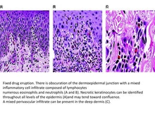Fixed drug eruption. There is obscuration of the dermoepidermal junction with a mixed
inﬂammatory cell inﬁltrate composed of lymphocytes
numerous eosinophils and neutrophils (A and B). Necrotic keratinocytes can be identiﬁed
throughout all levels of the epidermis (A)and may tend toward conﬂuence.
A mixed perivascular inﬁltrate can be present in the deep dermis (C).

 