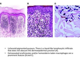 • Lichenoid pigmented purpura. There is a band-like lymphocytic inﬁltrate
that does not obscure the dermoepidermal junction (A).
• Extravasated erythrocytes and/or hemosiderin-laden macrophages are a
prominent feature (B and C).

 