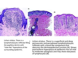 Lichen nitidus. There is a
•
lymphohistiocytic inﬁltrate ﬁlling
the papillary dermis with
"claw-like" hyperplasia of the
surrounding epidermis.

Lichen striatus. There is a superﬁcial and deep
perivascular and periadnexal lymphohistiocytic
inﬁltrate with a band-like component that
obscures the dermoepidermal junction (A). Shows
psoriasiform hyperplasia of epidermis Foci of mild
to moderate spongiosis and may show exocytosis
of lymphocytes (B).

 
