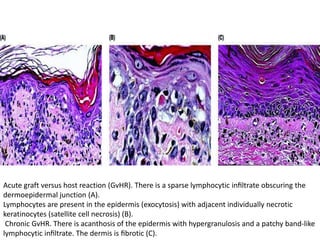 Acute graft versus host reaction (GvHR). There is a sparse lymphocytic inﬁltrate obscuring the
dermoepidermal junction (A).
Lymphocytes are present in the epidermis (exocytosis) with adjacent individually necrotic
keratinocytes (satellite cell necrosis) (B).
Chronic GvHR. There is acanthosis of the epidermis with hypergranulosis and a patchy band-like
lymphocytic inﬁltrate. The dermis is ﬁbrotic (C).

 