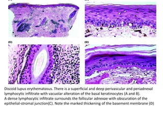 Discoid lupus erythematosus. There is a superﬁcial and deep perivascular and periadnexal
lymphocytic inﬁltrate with vacuolar alteration of the basal keratinocytes (A and B).
A dense lymphocytic inﬁltrate surrounds the follicular adnexae with obscuration of the
epithelial-stromal junction(C). Note the marked thickening of the basement membrane (D)

 