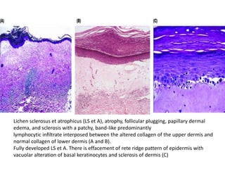 Lichen sclerosus et atrophicus (LS et A), atrophy, follicular plugging, papillary dermal
edema, and sclerosis with a patchy, band-like predominantly
lymphocytic inﬁltrate interposed between the altered collagen of the upper dermis and
normal collagen of lower dermis (A and B).
Fully developed LS et A. There is effacement of rete ridge pattern of epidermis with
vacuolar alteration of basal keratinocytes and sclerosis of dermis (C)

 
